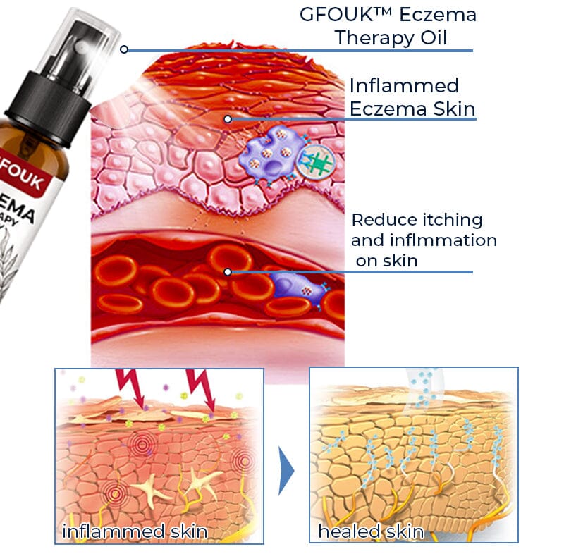 GFOUK™ Eczema Therapy Spray JC 1688 