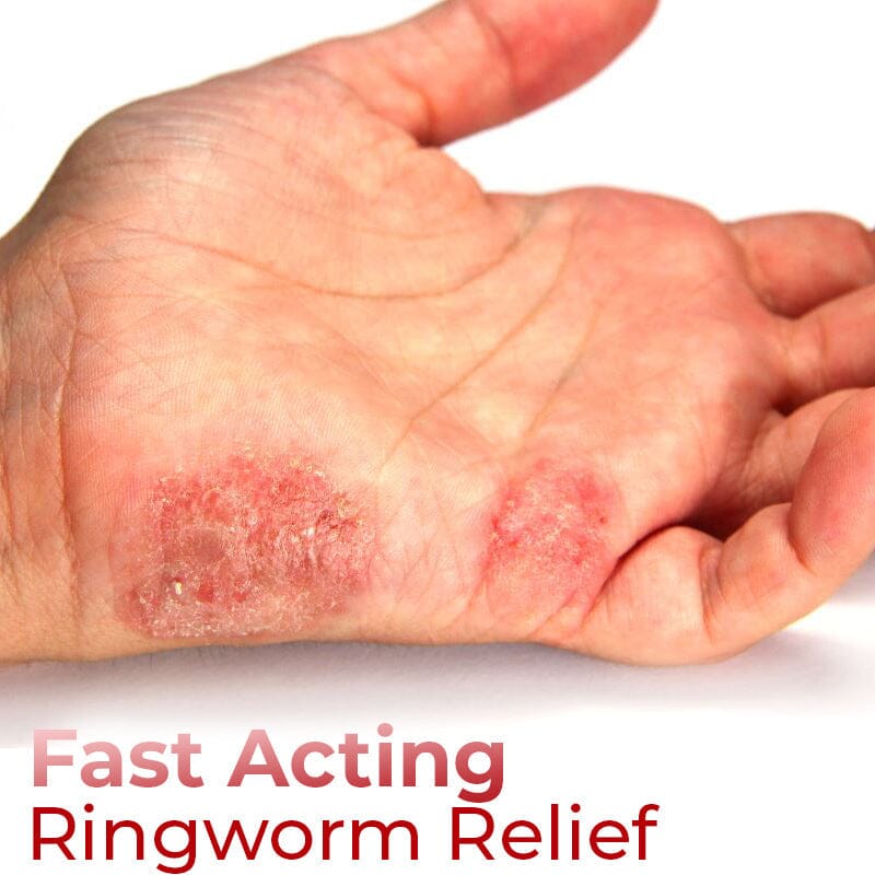GFOUK™ Hand Ringworm Relief Spray JC 1688 